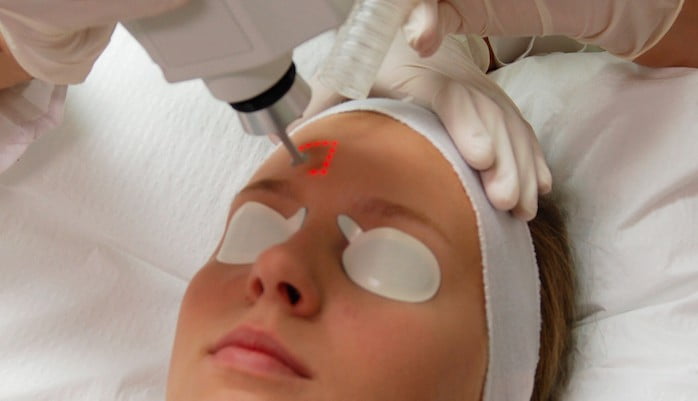 cicatrici acne