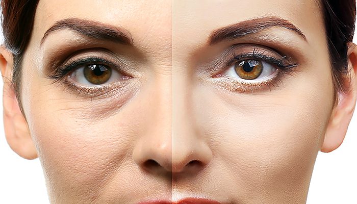 Togliere le occhiaie nere e scure con Volbella, filler di acido ialuronico